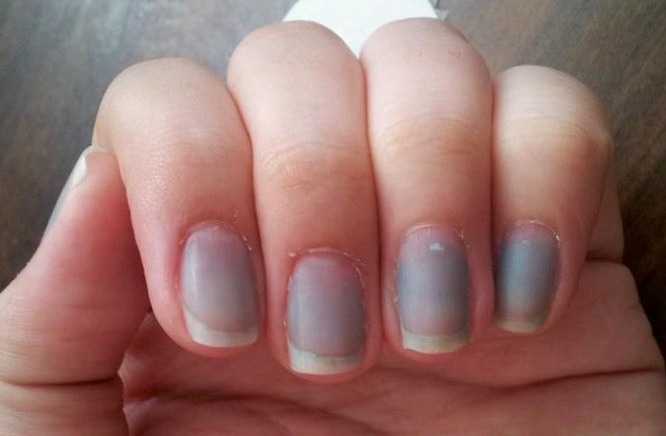 Causes of Abnormal Nail Bed Color - wide 6